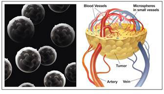 Yttrium-90 microspheres deliver radiation directly to tumors